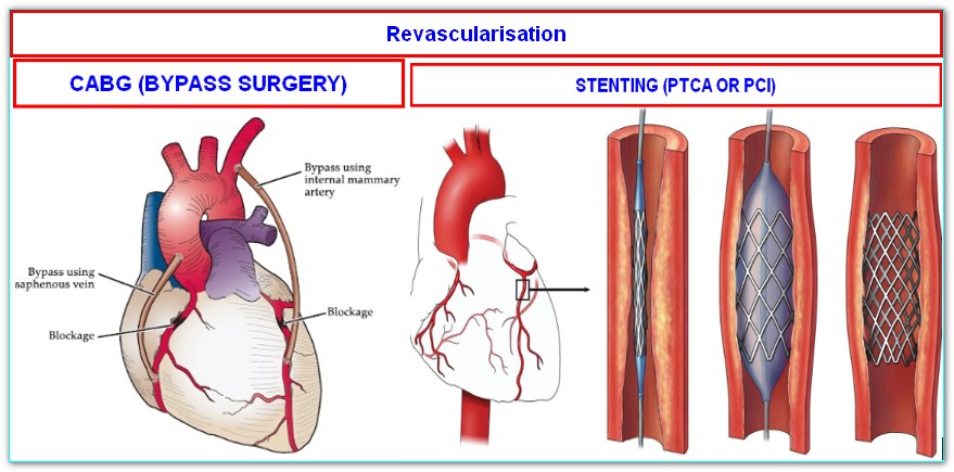What is cabg in cardiology